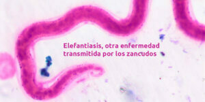 elefantiasis, otra enfermedad transmitida por los zancudos. blog – fumigación universal - fumigación universal, c.a - page 14 elefantiasis, otra enfermedad transmitida por los zancudos.